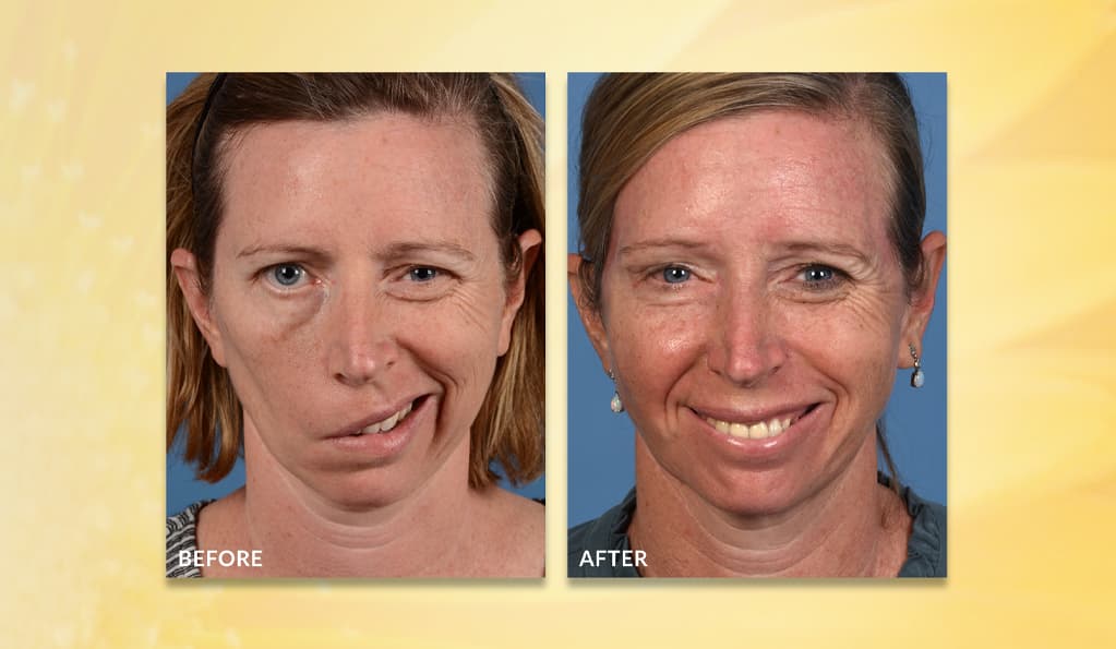 Dr. Rozen's patient before and after surgery