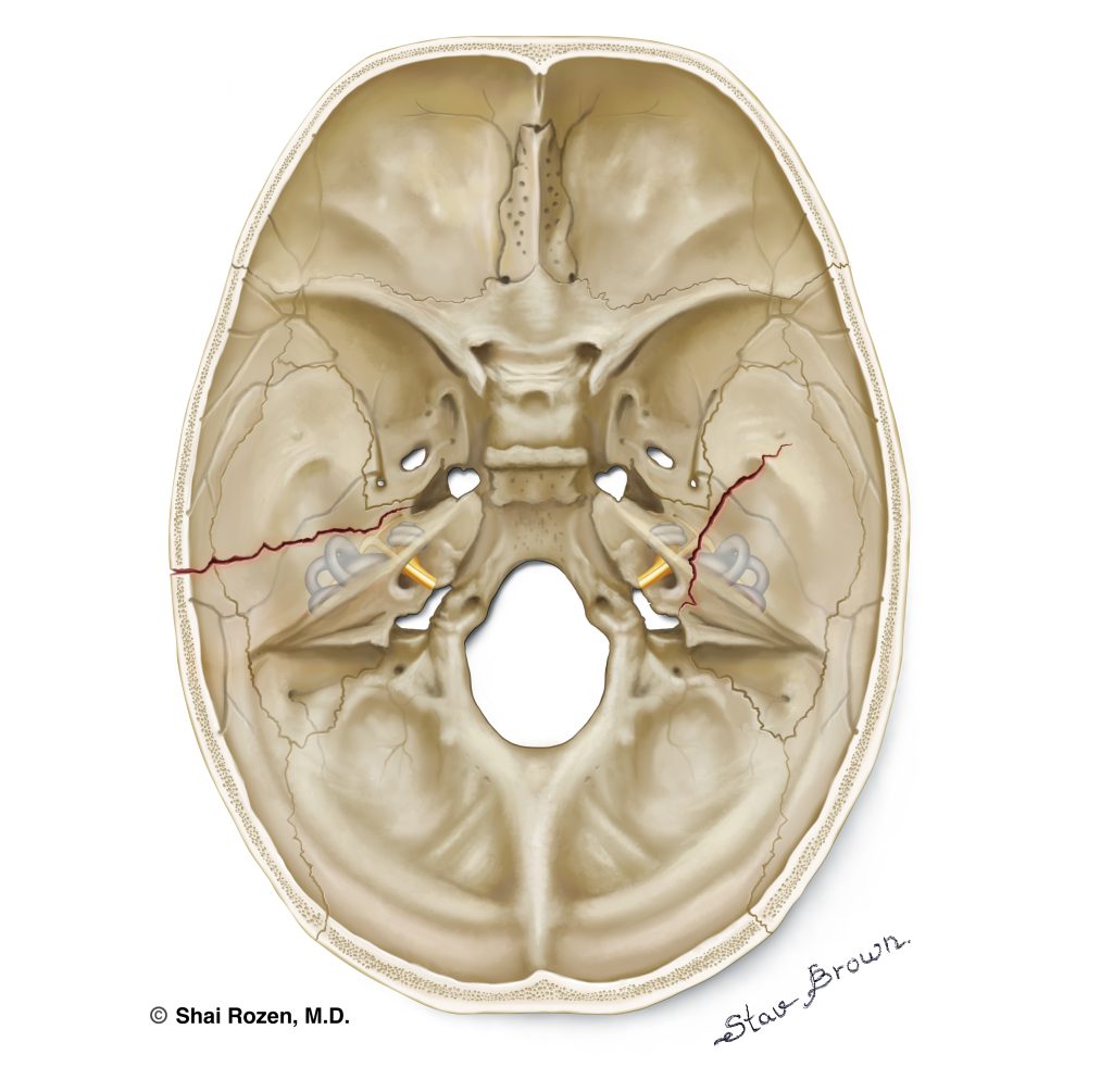 Cross section of a human skull with fractures