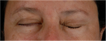 The patient with her eyes closed after treatment.