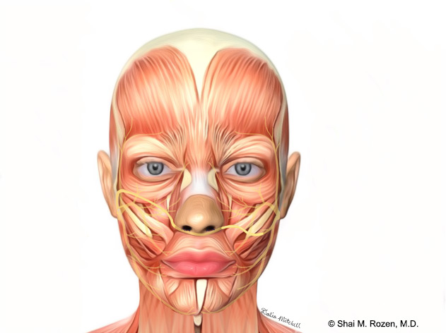 Cross facial nerve graft - front view: The nerve is crossed from the left healthy side into the right paralyzed side.