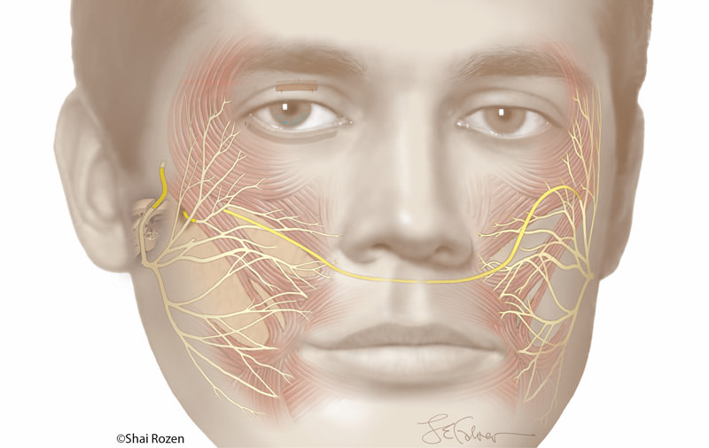 This illustration depicts several techniques used in the treatment of facial paralysis including cross facial nerve graft, nerve transfer, and intratemporal nerve grafting. The cross facial nerve graft (shown in yellow) crosses from one side of the face to the other.