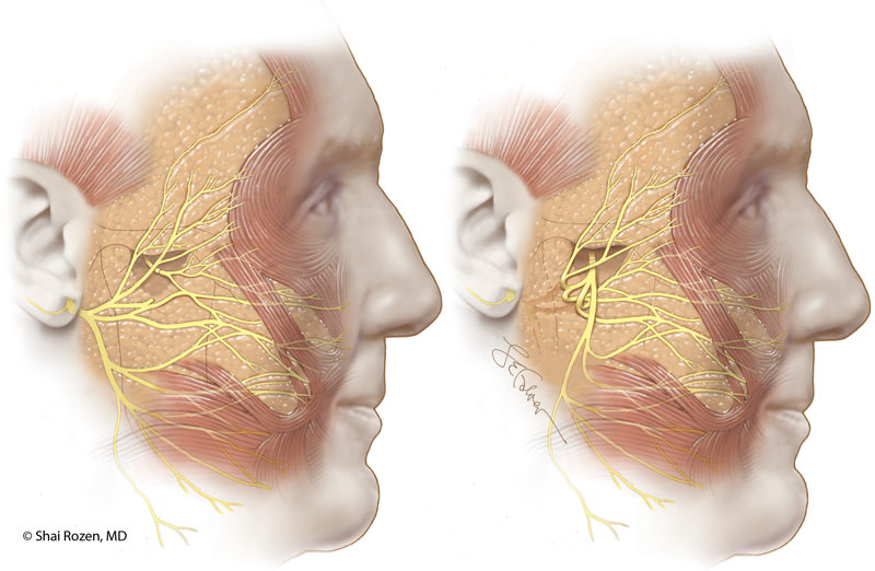 Several different configurations of nerve transfers, in this scenario nerve to masseter transfer to facial nerve