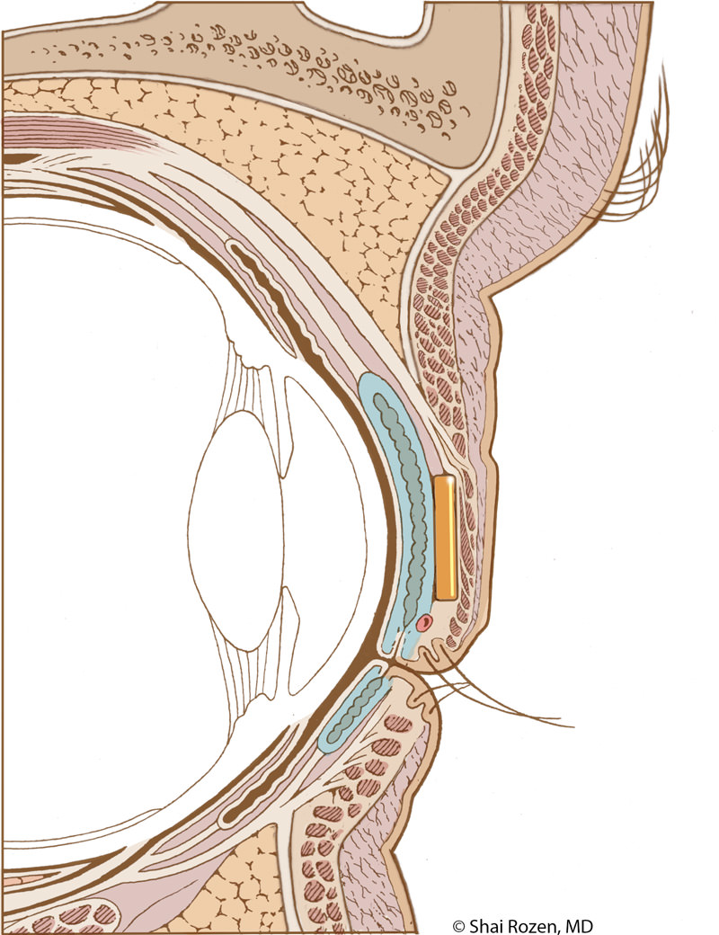 Traditional placement of an eyelid weight