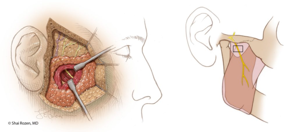 The figures depict the anatomy and position of the masseter nerve which is often used in both nerve transfers and functional muscle transplants in facial reanimation as described in a publication by Dr. Rozen. A Reliable Anatomic Approach for Masseter Nerve Dissection in the Setting of Facial Reanimation. J Plast Reconstr Aesthet Surg. 2013 May; 66(10). DOI: 10.1016/j.bjps.2013.04.009.