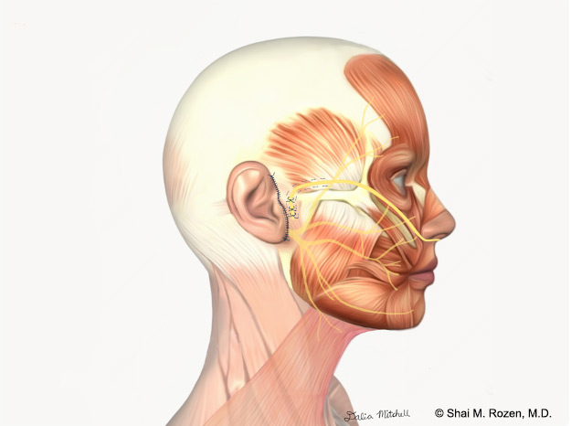 Cross facial nerve graft – side view: The nerve is placed in the right paralyzed side as preparation for a future muscle flap or sometimes as part of a nerve transfer strategy.