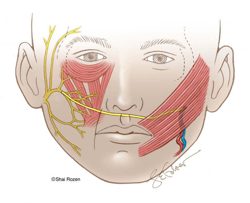 Muscle transplant - stage 2 of free functional muscle flap