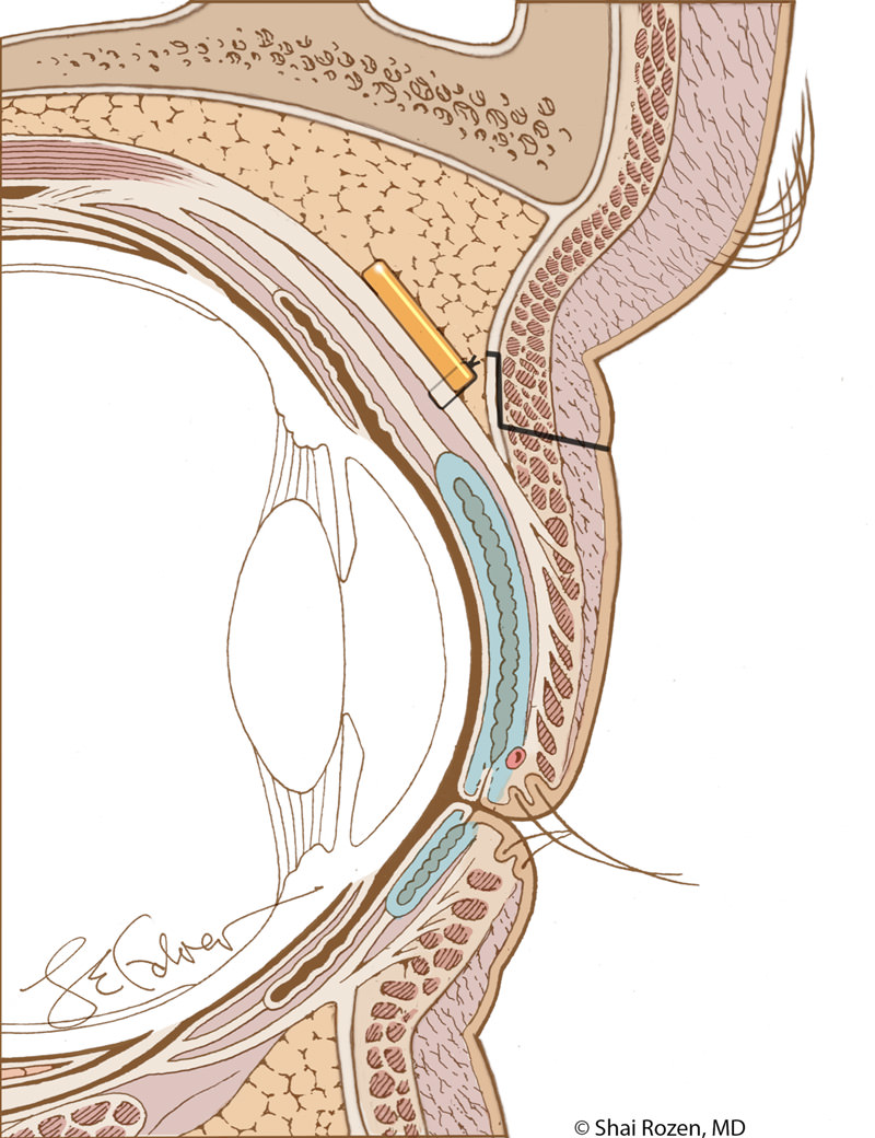 Improved placement of an eyelid weight