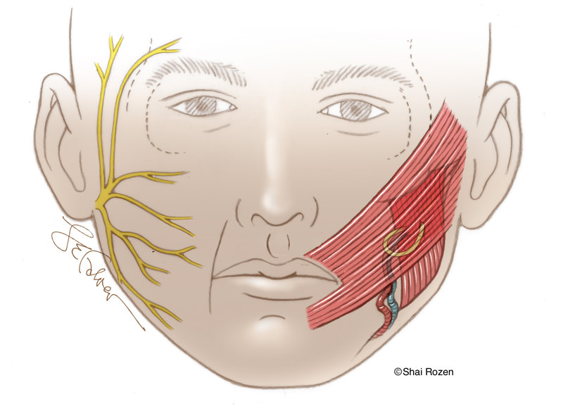Transplanted muscle connected to a nerve to masseter in one stage.
