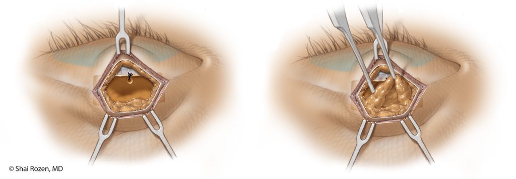 The weight is hidden behind the fat of the upper eyelid.