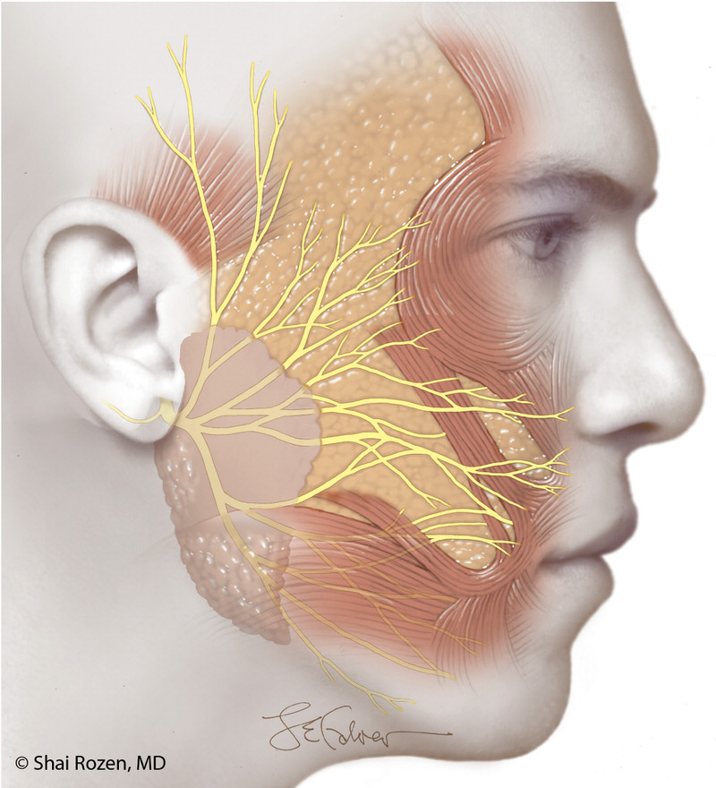 Dr. Rozen's group showed that a small dissection into the parotid gland significantly improves the chances to obtain more donor nerve fibers, likely improving outcomes of cross facial nerve grafts. (Facial Nerve Anatomic and Axonal Analysis: Optimizing Axonal Load for Cross Facial Nerve Grafting in Facial Reanimation. Plast Reconstr Surg. 2017 Jan;139(1):177-183. DOI: 10.1097/PRS.0000000000002897. PMID: 27632395. Cover Article.)