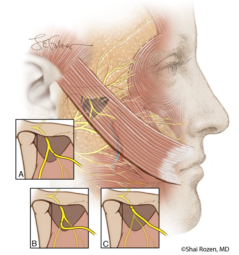 The figure depicts a side view of a transplanted muscle being innervated in one stage by a nerve to masseter. This is depicted in Dr. Rozen’s article on different salvage techniques with the nerve to masseter in difficult cases. The reuse of the nerve to masseter may be performed in both cases or nerve transfers if performed early enough or more commonly in cases of failed free functional muscle transplants. Reuse of The Masseteric Nerve for Dynamic Reanimation in Facial Palsy Patients with Previously Failed One-Stage Dynamic Smile Reanimation. Plast Reconstr Surg.  2019 Feb; 143(2):567-571; DOI: 10.1097/PRS.0000000000005253. PMID: 30688904