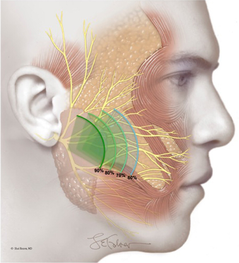 Dr. Rozen's group showed that a small dissection into the parotid gland significantly improves the chances to obtain more donor nerve fibers, likely improving outcomes of cross facial nerve grafts. (Facial Nerve Anatomic and Axonal Analysis: Optimizing Axonal Load for Cross Facial Nerve Grafting in Facial Reanimation. Plast Reconstr Surg. 2017 Jan;139(1):177-183. DOI: 10.1097/PRS.0000000000002897. PMID: 27632395. Cover Article.)