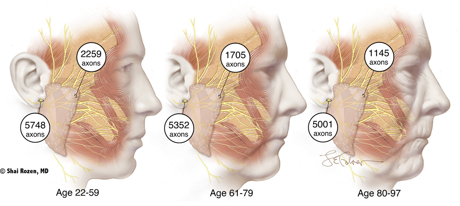 Dr. Rozen's group demonstrated that axonal counts (number of nerve fibers) change with age and should be taken into consideration when deciding on a treatment strategy. (Correlation Between Facial Nerve Axonal Load and Age and Its Relevance to Facial Reanimation. Plast Reconstr Surg. 2017 Jun;139(6):1459-1464. DOI: 10.1097/PRS.0000000000003376. PMID: 28198771.)