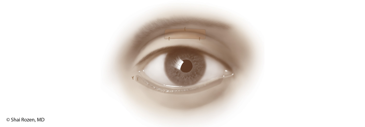 Final placement of the upper eyelid weight in a well-hidden position