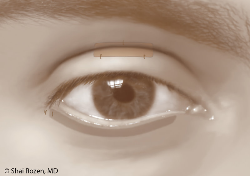  Lateral tarsal strip under the eye