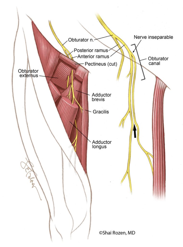 This  figure depicts the gracilis muscle which is commonly used for muscle transplantation and its innervation.