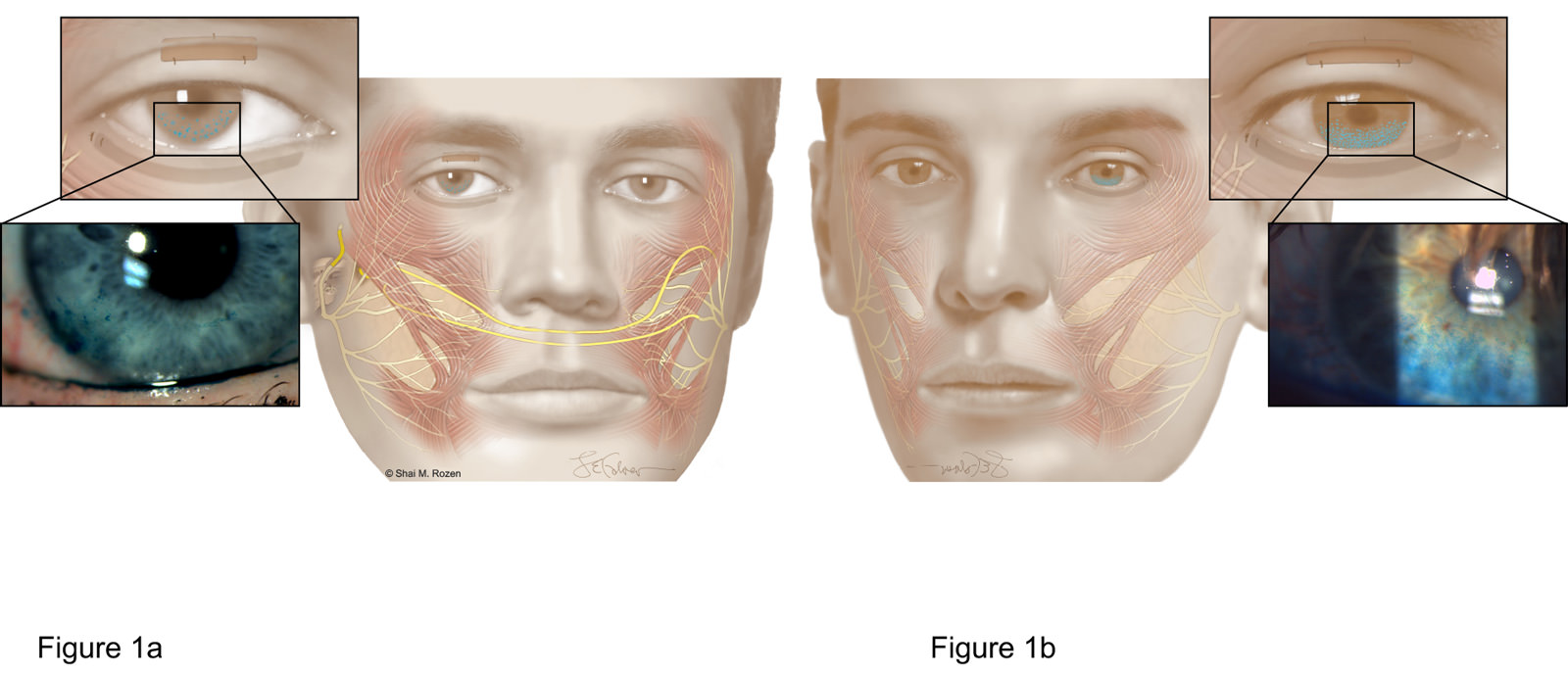 Dr. Rozen and his team compared the corneal integrity and ability to close the eyelids between 2 treatment groups. Figure 1a depicts patients who underwent dynamic reanimation of the eyelids with renervation techniques. Figure 1b depicts patients who could only undergo passive techniques for eye protection. Patients who underwent dynamic reanimation with renervation techniques (Figure 1a) had more corneal protection and improved eye closure in long-term follow-ups.