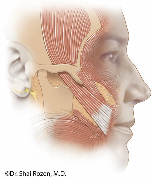 Temporalis lengthening myoplasty