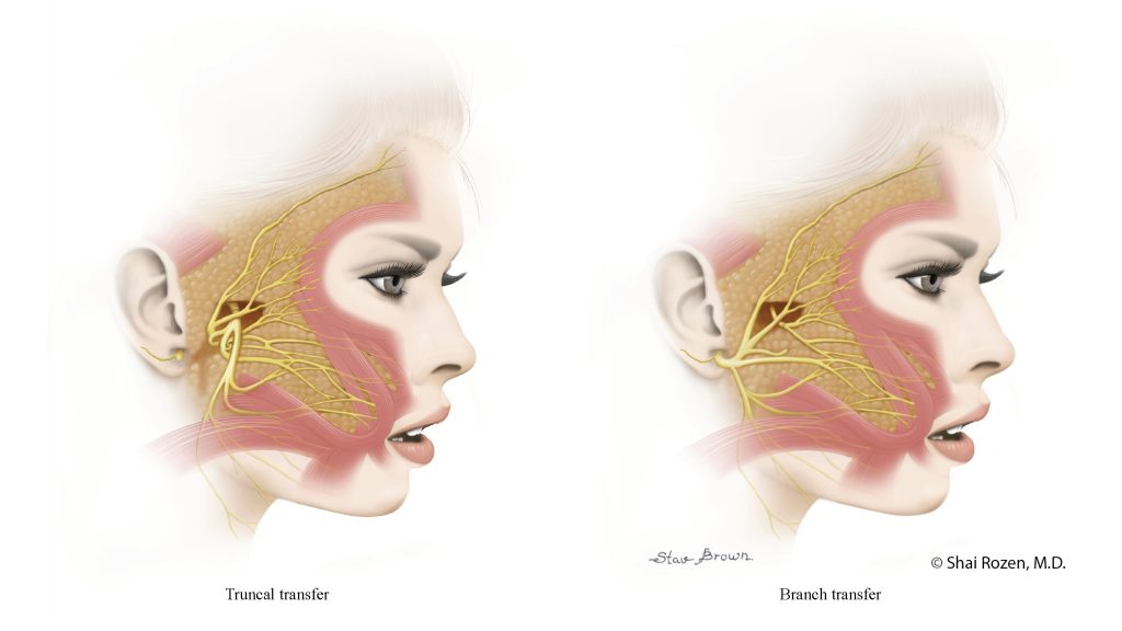 Two types of nerve transfers that are used depending on the patient's current condition and chances of future recovery.