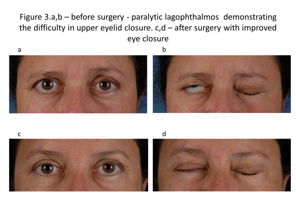 Before and after surgery - paralytic lagophthalmos. Demonstrating the difficulty in upper eyelid closer and improved eye closure after surgery
