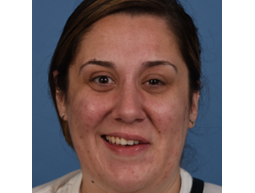 Woman with Bell's Palsy-related synkinesis before selective myectomy and neurectomies