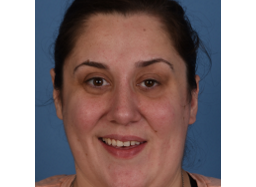 Woman with Bell's Palsy-related synkinesis after selective myectomy and neurectomies