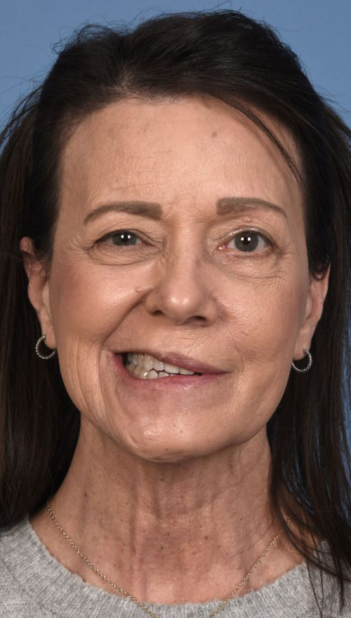 Photo showing a 62-year-old woman presented 6 months after acoustic neuroma resection, at which time she began recovering facial tone, subtle motion, and showing early signs of synkinesis