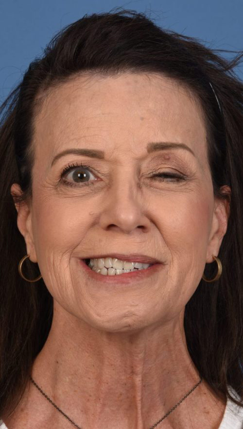 Photo showing at 15 months, her synkinesis symptoms had worsened compared to 10 months