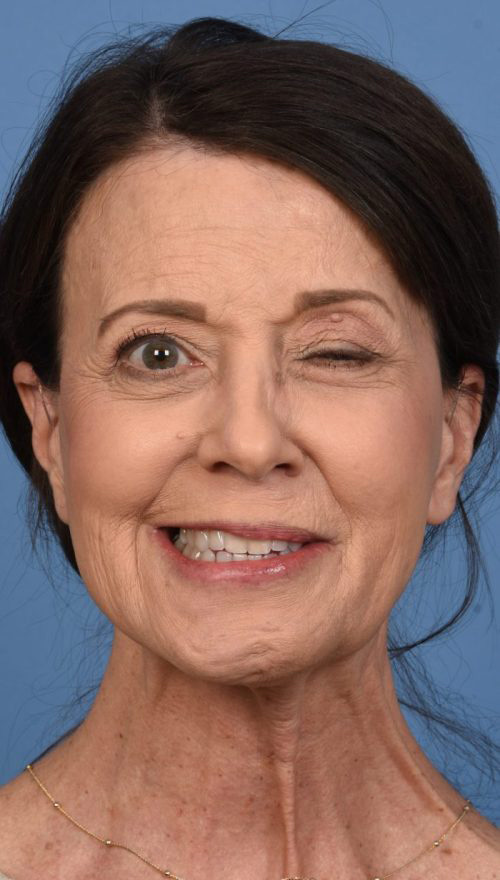 Photo showing that by 19 months, her symptoms were comparable to those at 15 months, indicating a plateau in severity