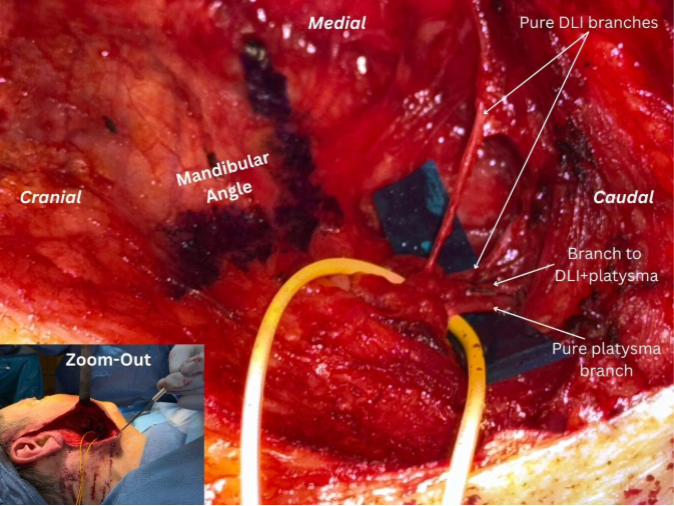 Intraoperative surgical view of lower facial nerve branches near the mandibular angle, showing labeled DLI and platysma nerve branches with directional markers (cranial, caudal, medial) and a small inset image of the surgical setup.
