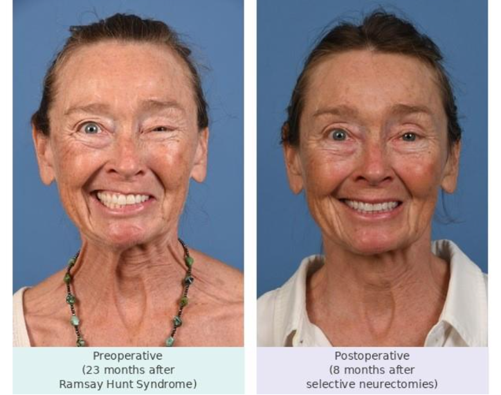 A 60-year-old patient with left facial synkinesis secondary to Ramsay Hunt Syndrome. Left: preoperative appearance 23 months after facial palsy onset. Right: 8 months after selective neurectomies, including marginal mandibular neurectomy, DAO and orbicularis oculi myectomies, with preservation of the cervical DLI branches. 