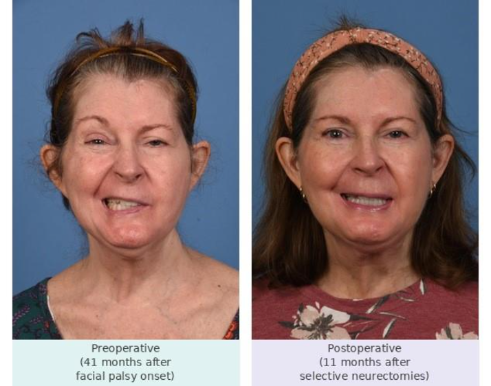 A 64-year-old patient with left facial synkinesis secondary to temporomandibular joint surgery. Left: preoperative appearance 41 months after facial palsy onset. Right: 11 months after selective neurectomies, including marginal mandibular neurectomy and cross facial nerve graft, with preservation of the cervical DLI branches.