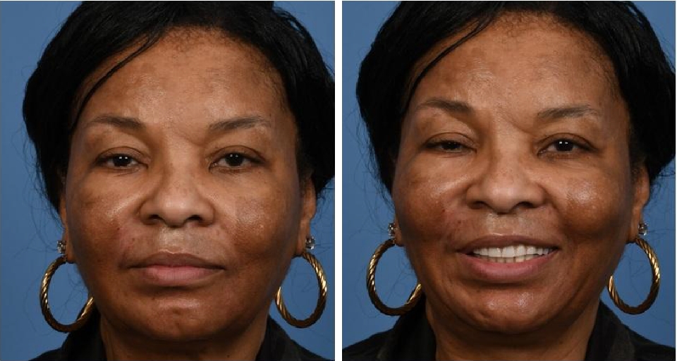 Photos of patient with Bell's Palsy after surgery, resting and smiling.