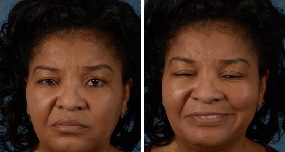 Photos of patient with Bell's Palsy, resting and smiling, who received BOTOX treatments. 